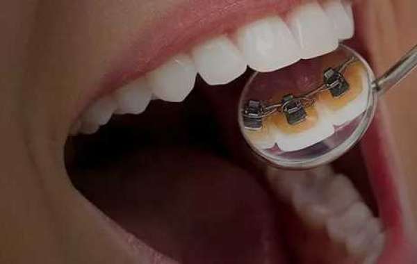 Smile Confidently with Lingual Braces